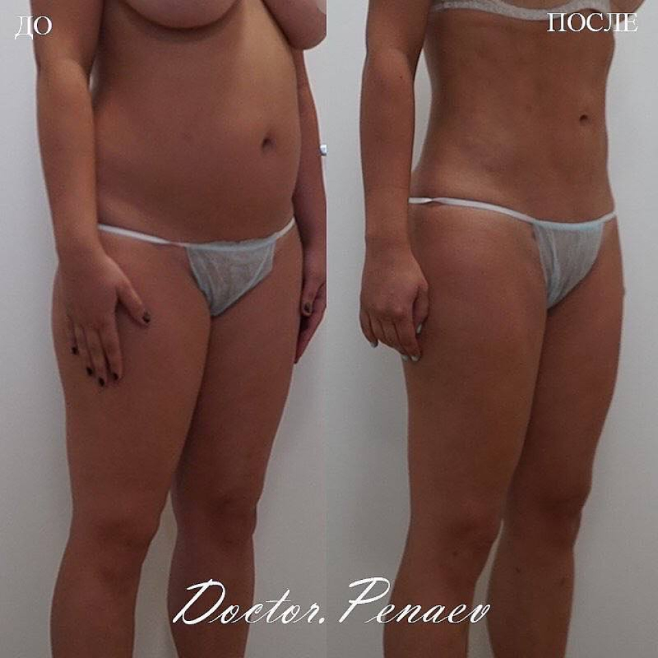 Пациентка (31 год) пластического хирурга Арслана Пенаева до и после бодидизайна