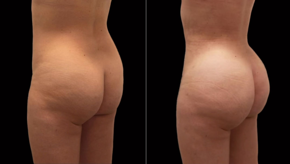 Фото пациентки доктора Гукаса Миракяна до и после липофилинга ягодиц