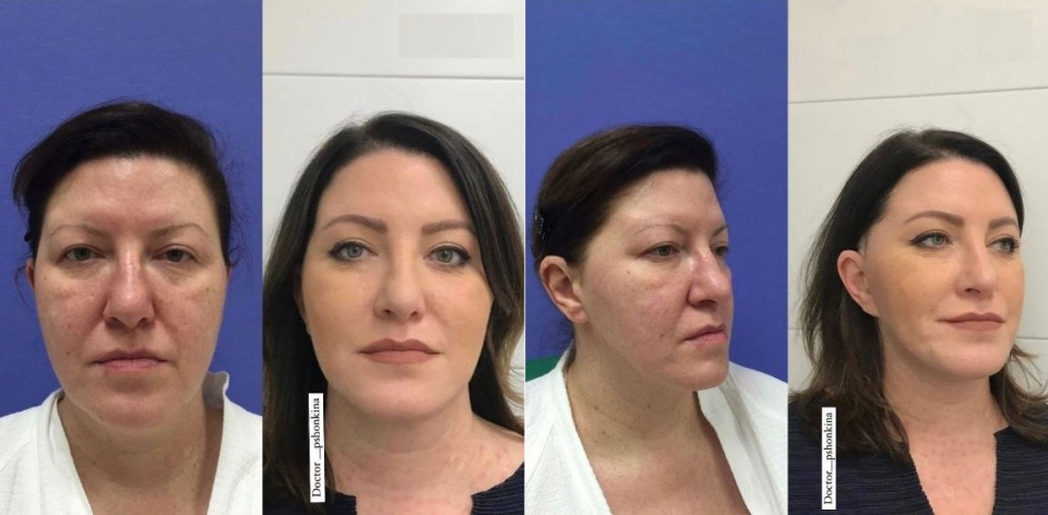 Пациентка пластического хирурга Светланы Пшонкиной до и после комбинированной операции по подтяжке лица