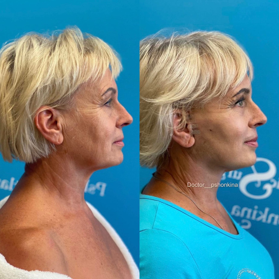 Пациентка пластического хирурга Светланы Пшонкиной. Фото до и после хирургической СМАС подтяжки лица.