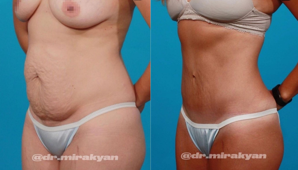 Пациентка пластического хирурга Гукаса Миракяна на фото до и после подтяжки живота и липосакции спины