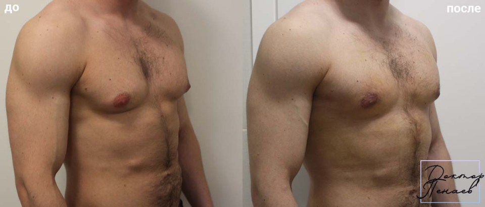 Пациент пластического хирурга Арслана Пенаева до и после устранения гинекомастии. Для удаления избыточного жира была выбрана вазер-липосакция.