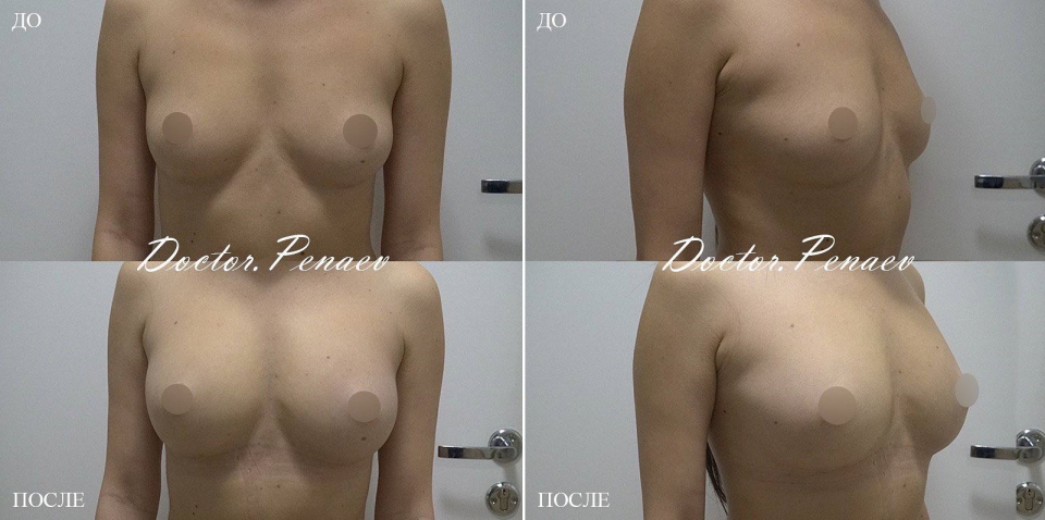 Пациентка пластического хирурга Арслана Пенаева до и после увеличения груди с помощью пересадки жира. Результат представлен через 1 месяц после липотрансфера груди