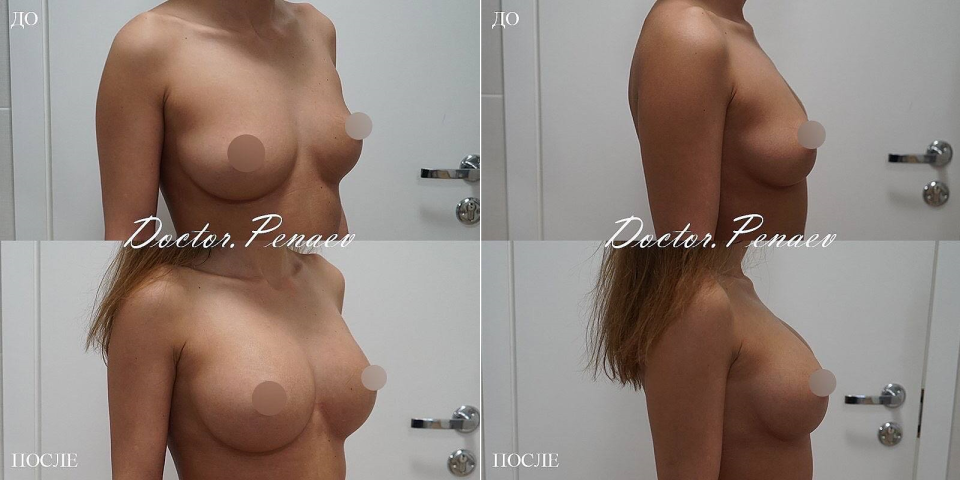 Пациентка пластического хирурга Арслана Пенаева до и после увеличения груди с помощью пересадки жира.