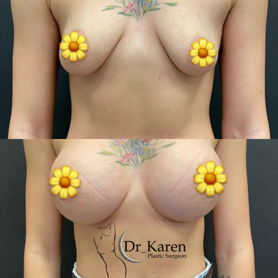 Пациентка пластического хирурга Карена Пайтяна до и после увеличения груди имплантами
