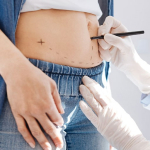 Подтяжка живота после кесарева сечения