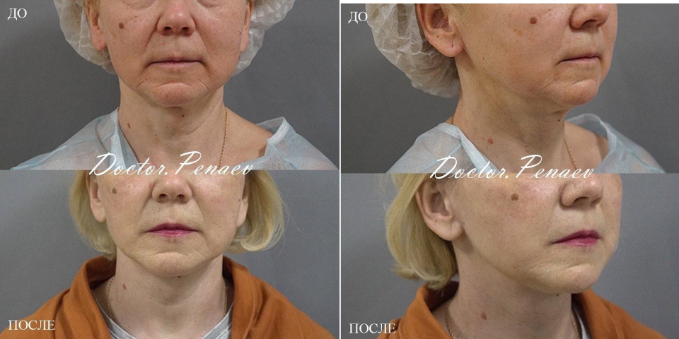 Омоложение лица. Пациентка доктора Арслана Пенаева до и после СМАС-пластики лица