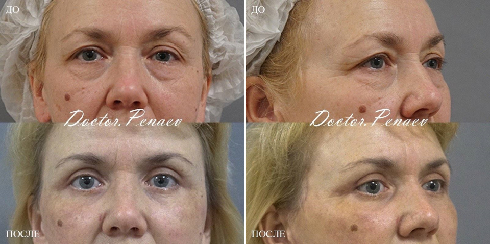 Пациентка доктора Арслана Пенаева до и после СМАС-пластики лица