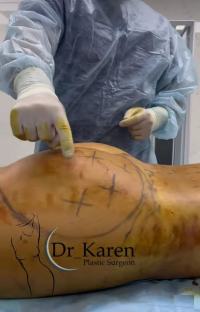 Липофилинг ягодиц у хирурга Карена Пайтяна