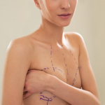  Увеличение груди с подтяжкой: когда вместе лучше?