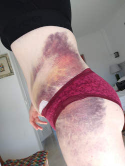 Гематомы после липосакции