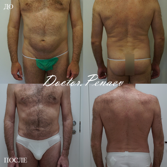 Пациент (51 год) пластического хирурга Арслана Пенаева. Фото до и после липомоделирования тела.