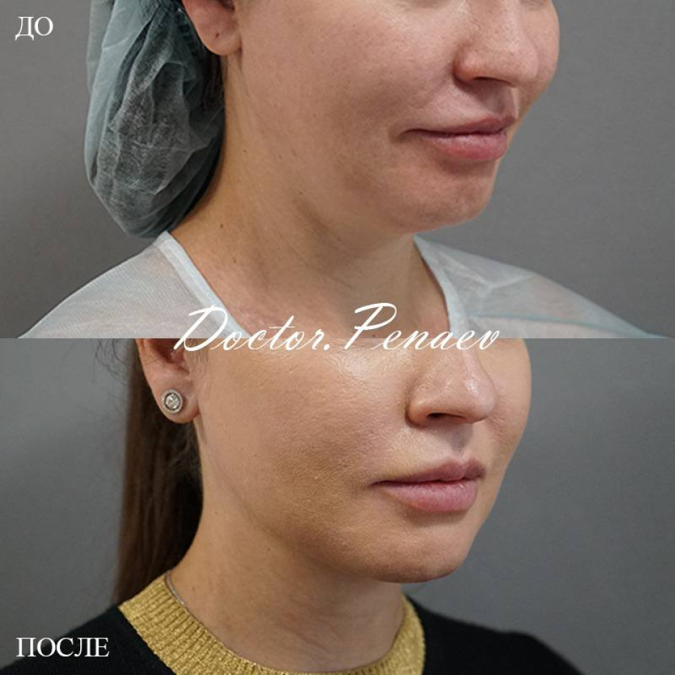 Пациентка хирурга Арслана Пенаева до и после мультитехнологичного лифтинга лица и процедуры Вечный ботокс