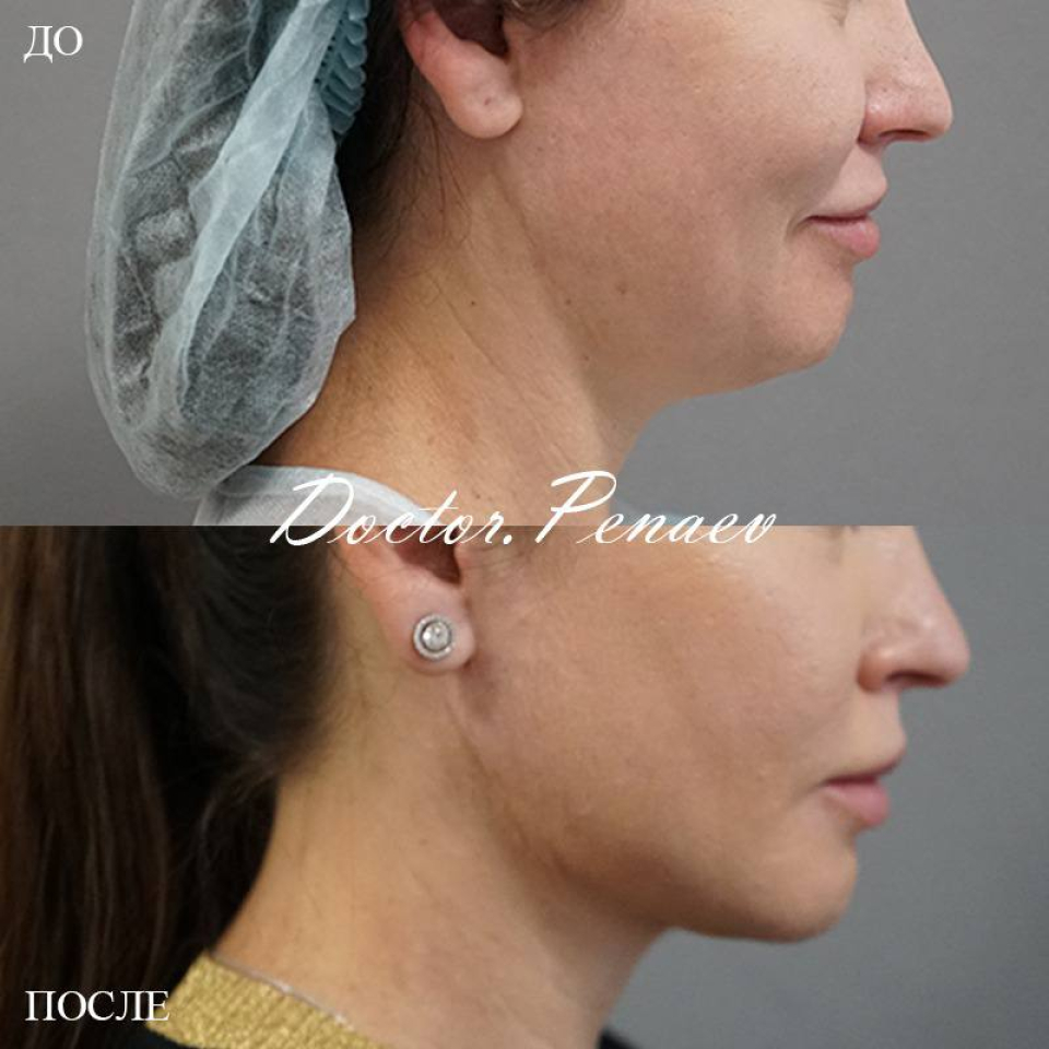 Пациентка пластического хирурга Арслана Пенаева. Фото до и после омоложения по методике «Мультитехнологичный лифтинг лица»