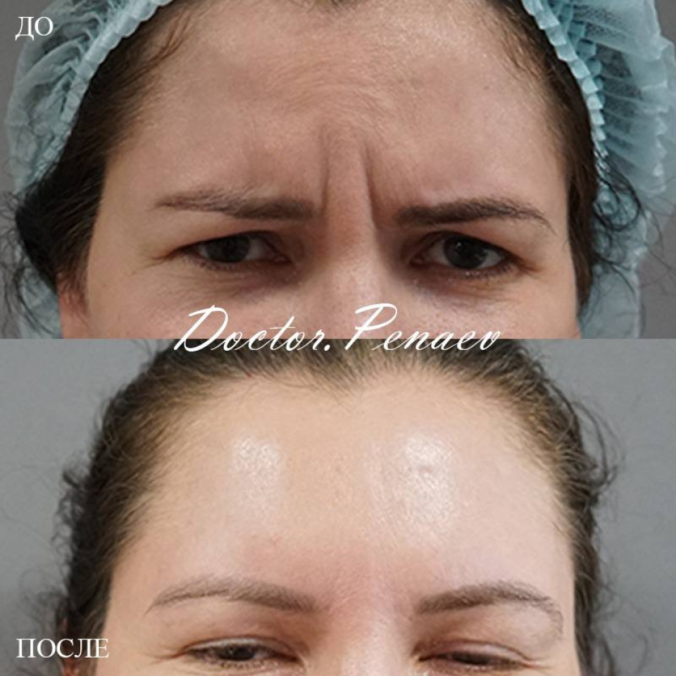 Пациентка пластического хирурга Арслана Пенаева. Фото до и после методики «Вечный Ботокс»