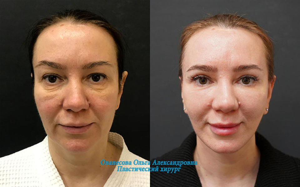Пациентка хирурга Ольги Ованесовой до и после комплексной подтяжки лица и шеи и удаления малярных мешков
