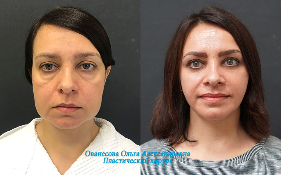 Пациентка доктора Ольги Ованесовой до и после омоложения и удаления малярных мешков