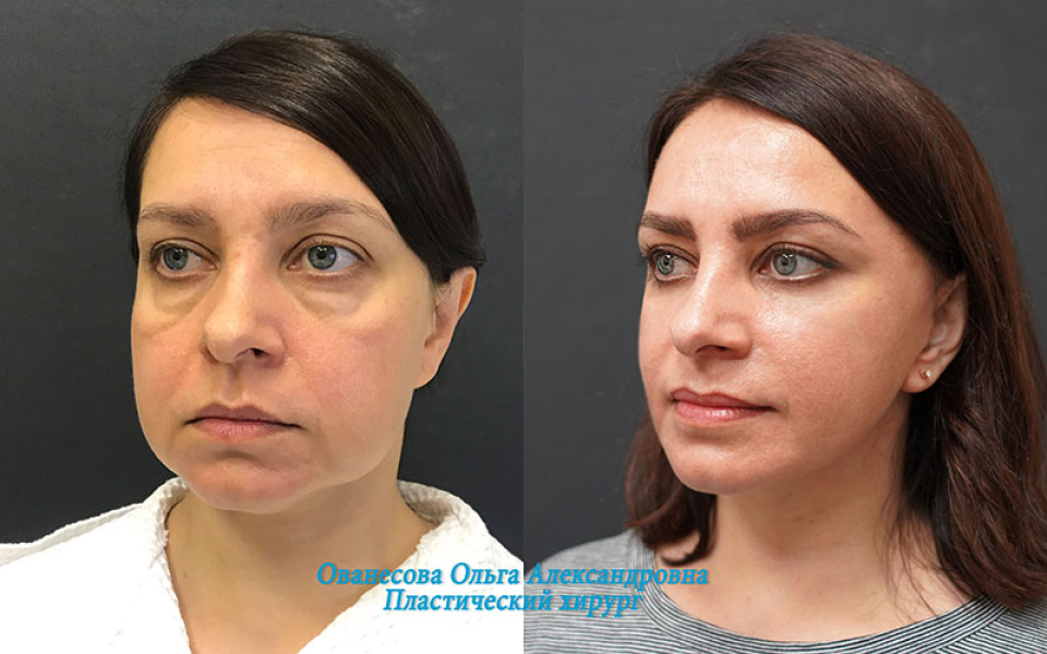 Пациентка доктора Ольги Ованесовой до и после омоложения и удаления малярных мешков