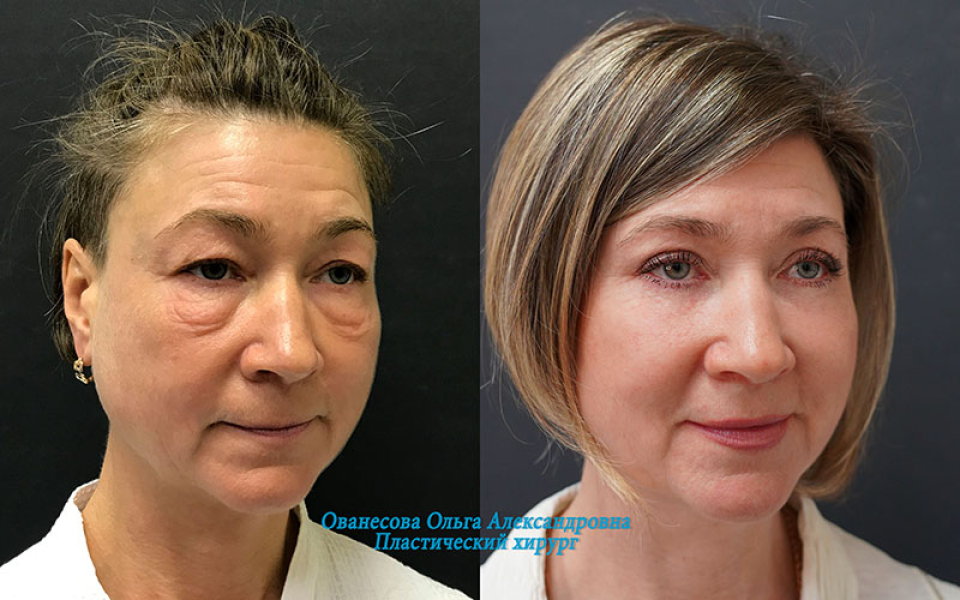 Пациентка пластического хирурга Ольги Ованесовой до и после блефаропластики и удаления малярных образований