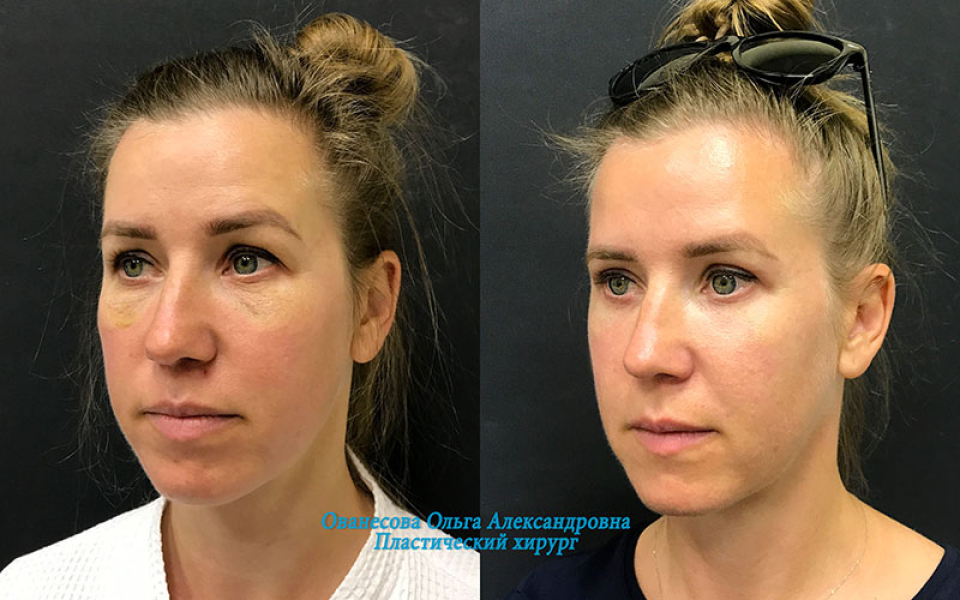 Пациентка хирурга Ольги Ованесовой до и после удаления малярных мешков и блефаропластики нижних и верхних век