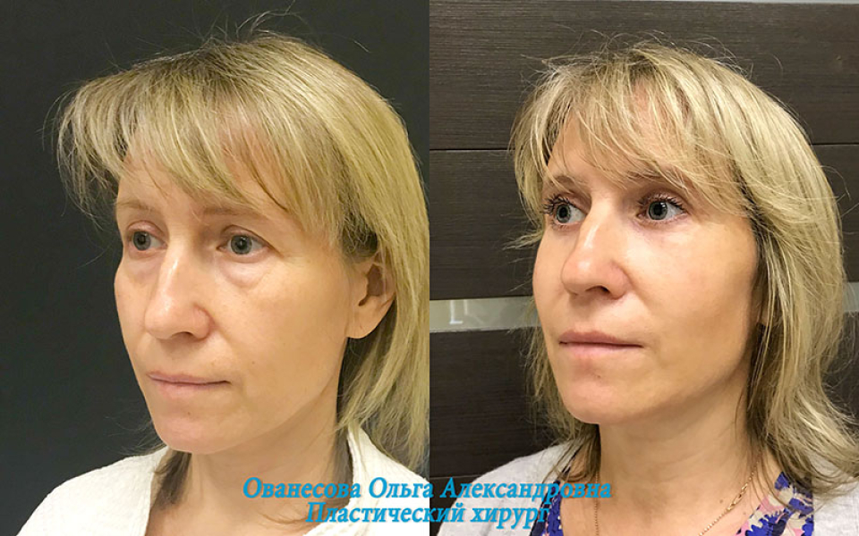 Пациентка доктора Ольги Ованесовой до и после удаления малярных мешков и круговой блефаропластики