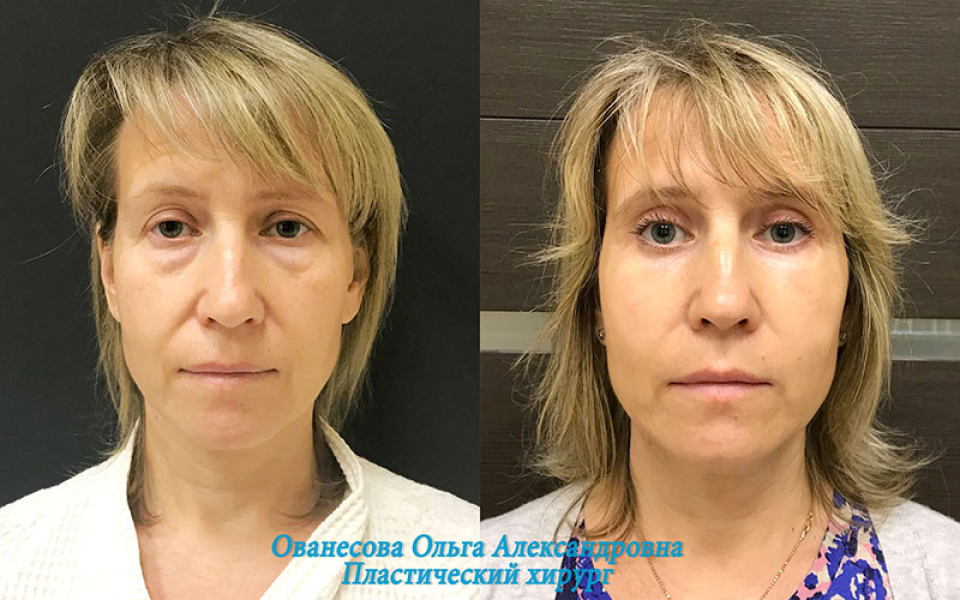 Пациентка доктора Ольги Ованесовой до и после удаления малярных мешков и круговой белфаропластики