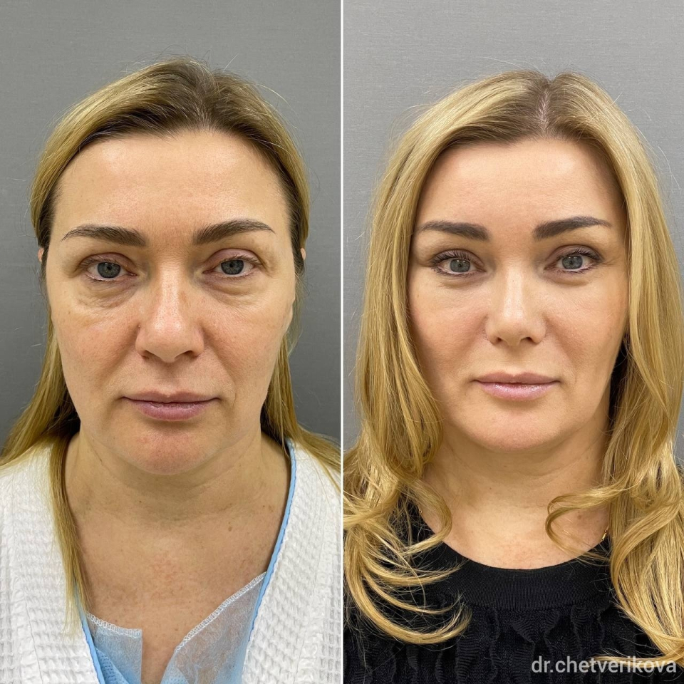 Пациентка пластического хирурга Марины Четвериковой до и после омоложения