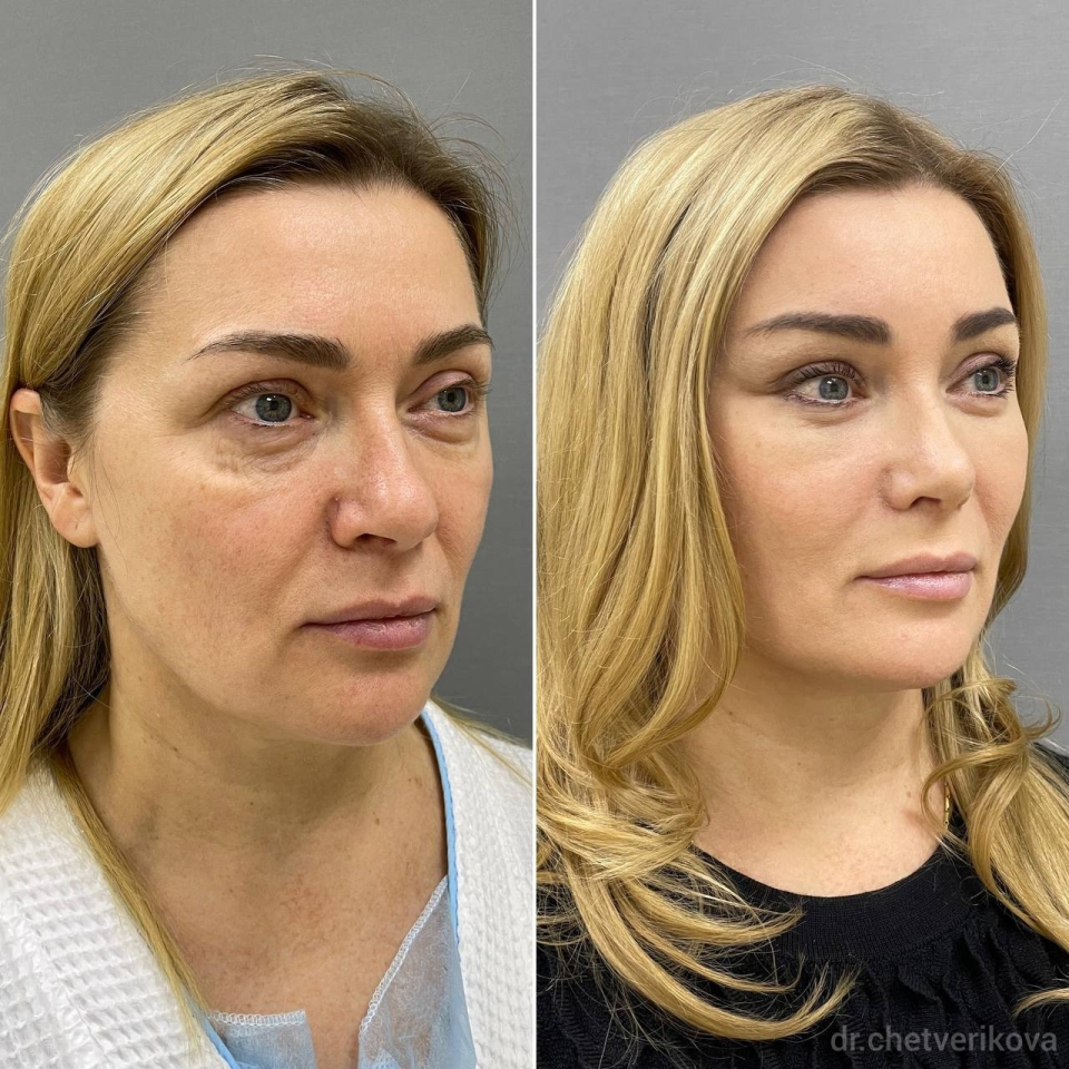 Пациентка пластического хирурга Марины Четвериковой до и после омоложения лица
