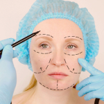 Какими бывают рубцы после подтяжки лица	