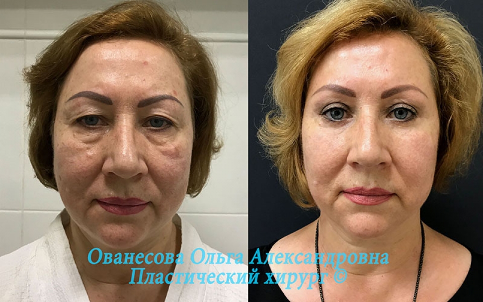 Пластическая операция уфа. Пластическая операция уфа. Пластическая операция уфа. Спейслифтинг до и после. Пластика носа.