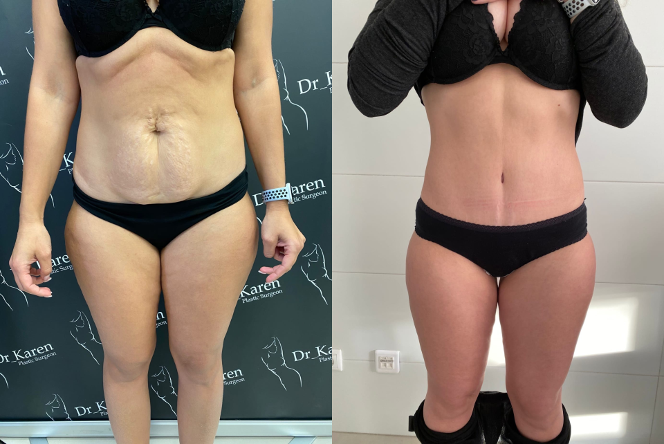 Пациентка доктора Карена Пайтяна. Фото до и на осмотре через 3 месяца после круговой липосакции и абдоминопластики с переносом пупка и с ушиванием диастаза