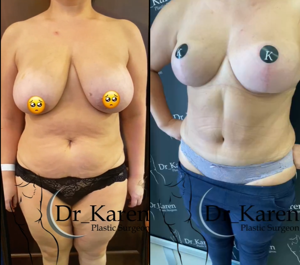 Пациентка доктора Карена Пайтяна. Фото до и на осмотре через 6 месяцев после комбинированной операции по проекту «POSTNATAL».