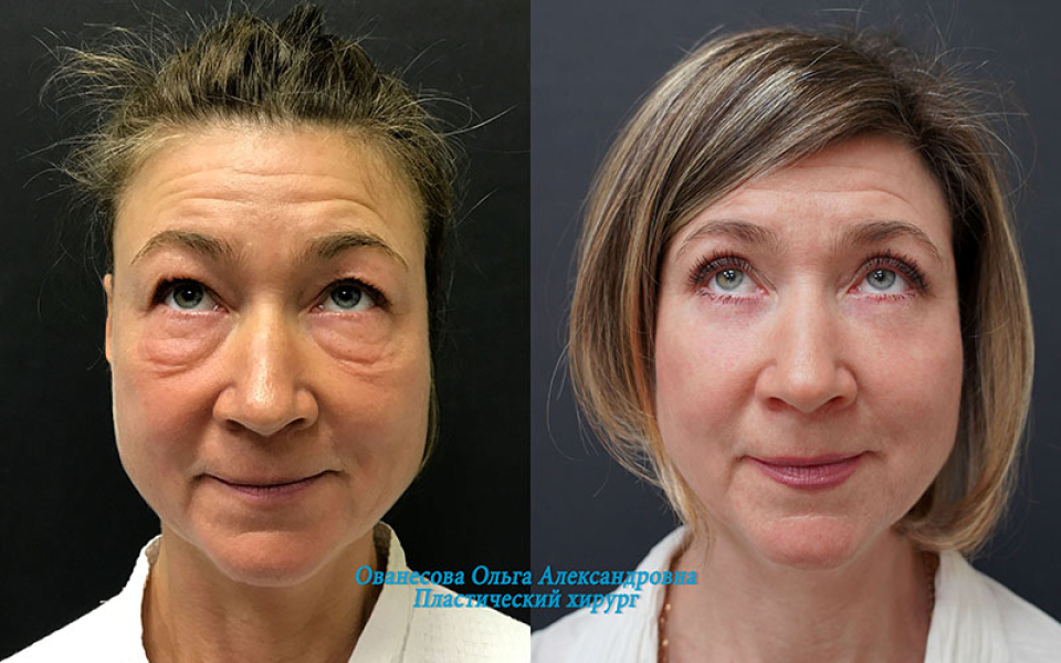 Пациентка пластического хирурга Ольги Ованесовой до и после блефаропластики и удаления малярных образований