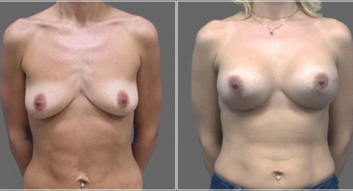 Пациентка пластического хирурга Дмитрия Рябцева. Фото до и после увеличения груди имплантатами