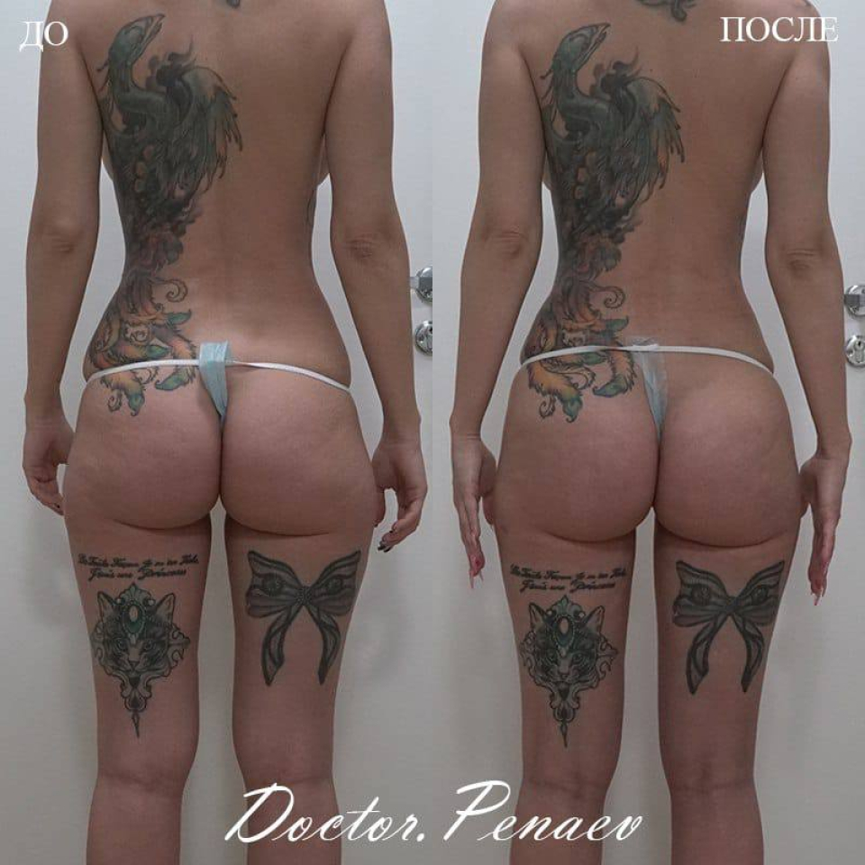 Пациентка (33 года) доктора Арслана Пенаева. Фото до и после вазер-липосакции и липотрансфера ягодиц