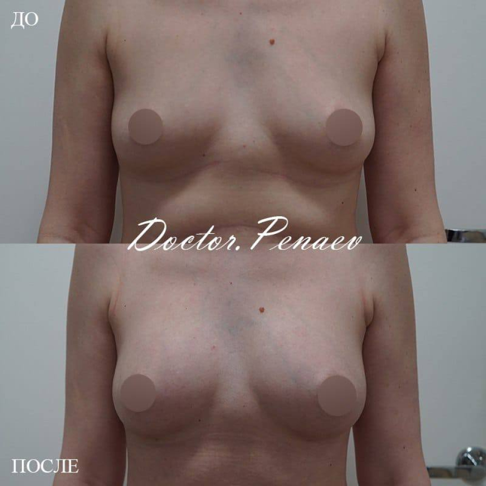 Пациентка доктора Арслана Пенаева. Фото до и после липотрансфера груди. Результат через 3 месяца после операции