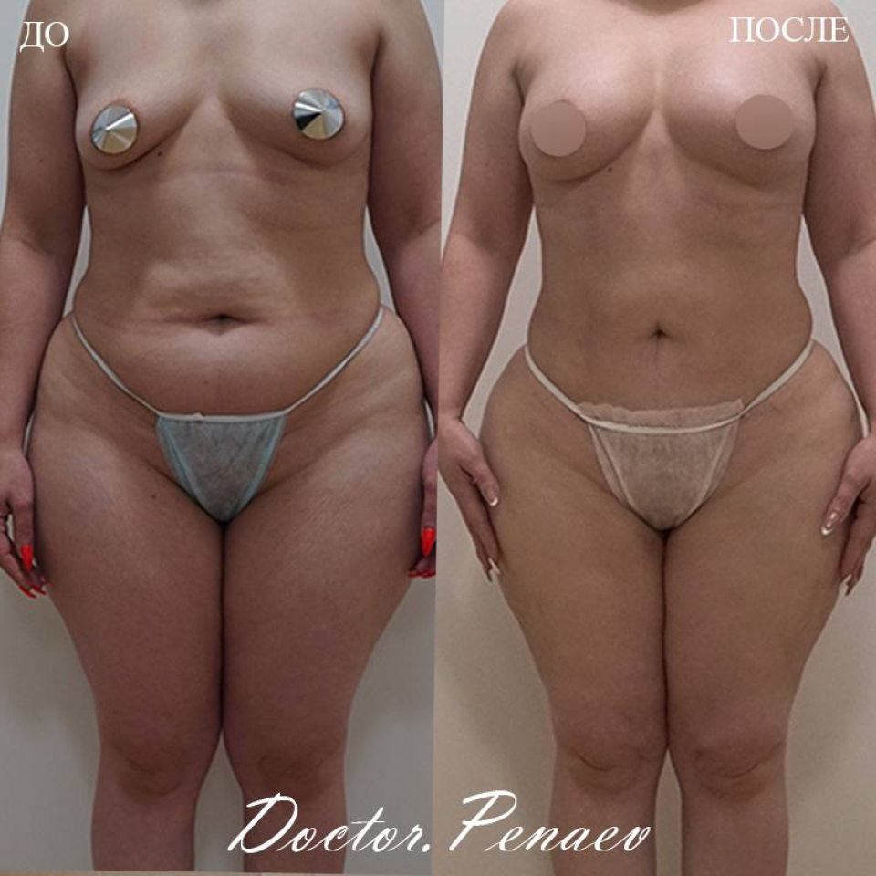 Пациентка хирурга Арслана Пенаева до и после мультизональной вазер-липосакции и липофилинга груди