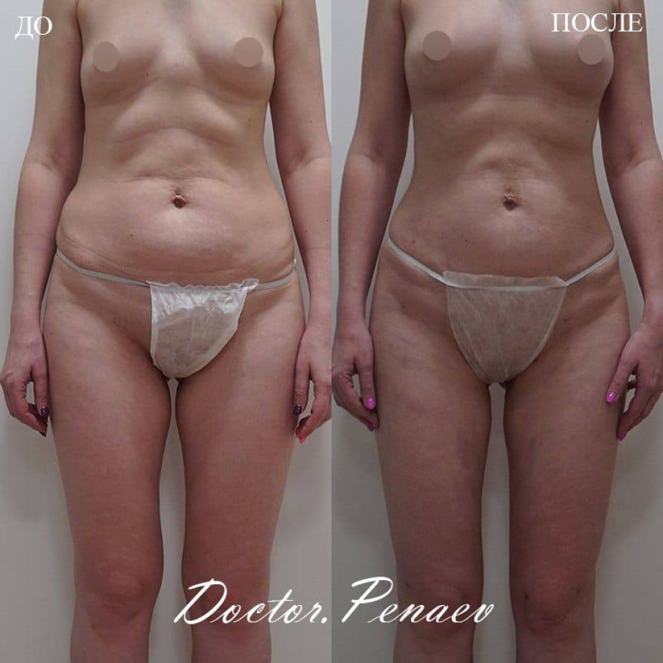 Пациентка доктора А.А. Пенаева, 41 год. Женщине выполнена мультизональная VASER-липосакция и липотрансфер грудей
