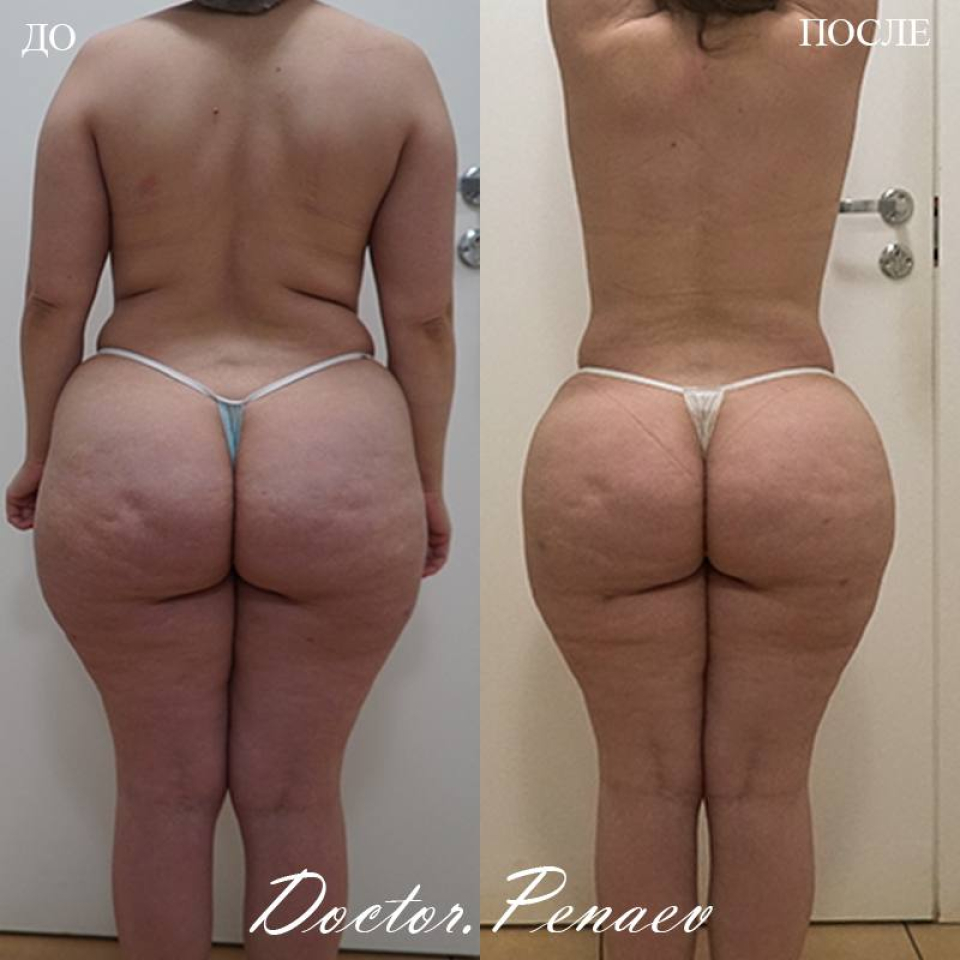 Пациентка доктора А.А. Пенаева, 43 года. Выполнена  мультизональная VASER-липосакция