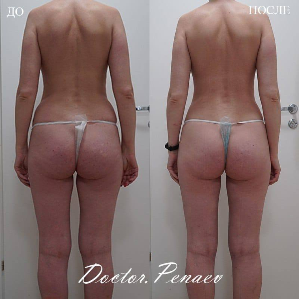 Пациентка доктора А.А. Пенаева, 41 год. Женщине выполнена мультизональная VASER-липосакция и липотрансфер грудей