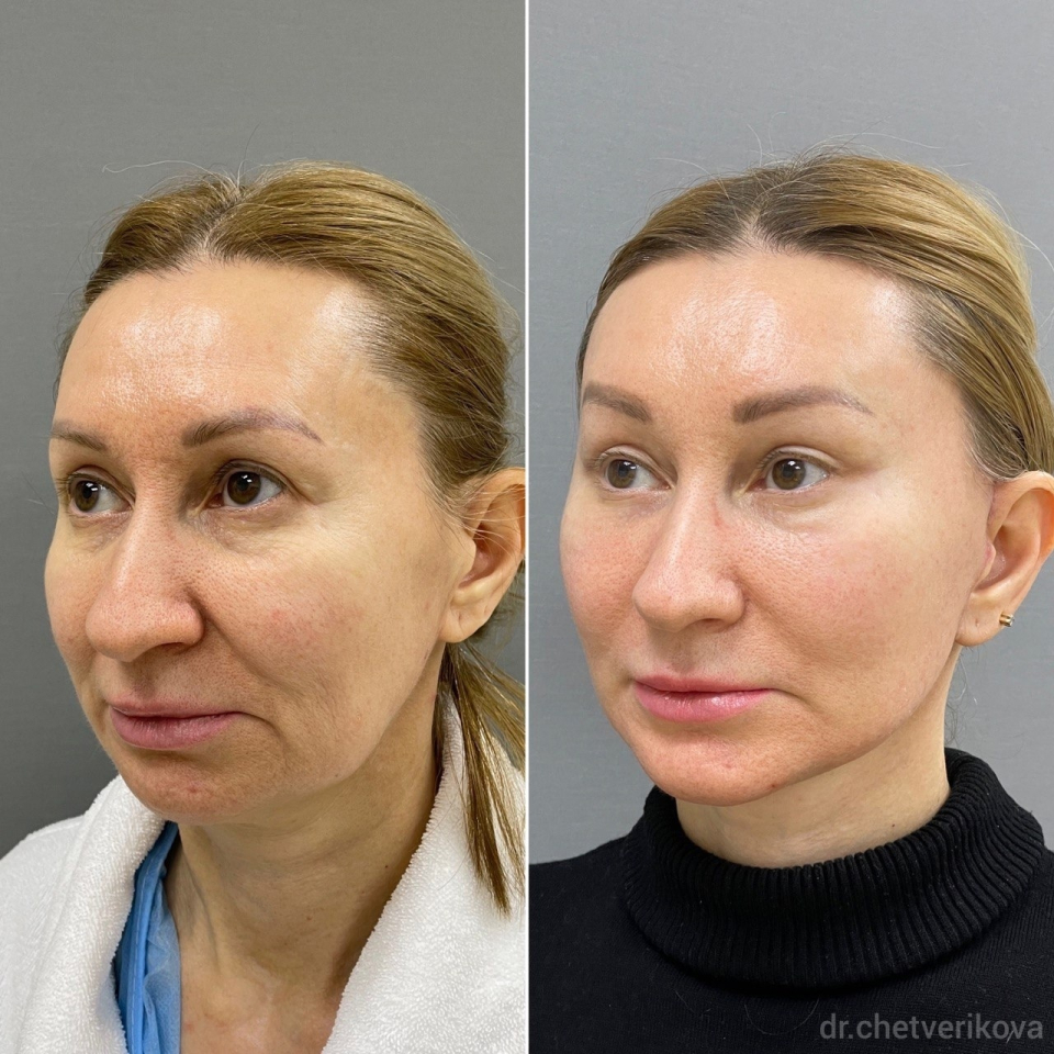 Пациентка пластического хирурга Марины Четвериковой до и через 1 месяц после комплексного омоложения лица и установки импланта подбородка