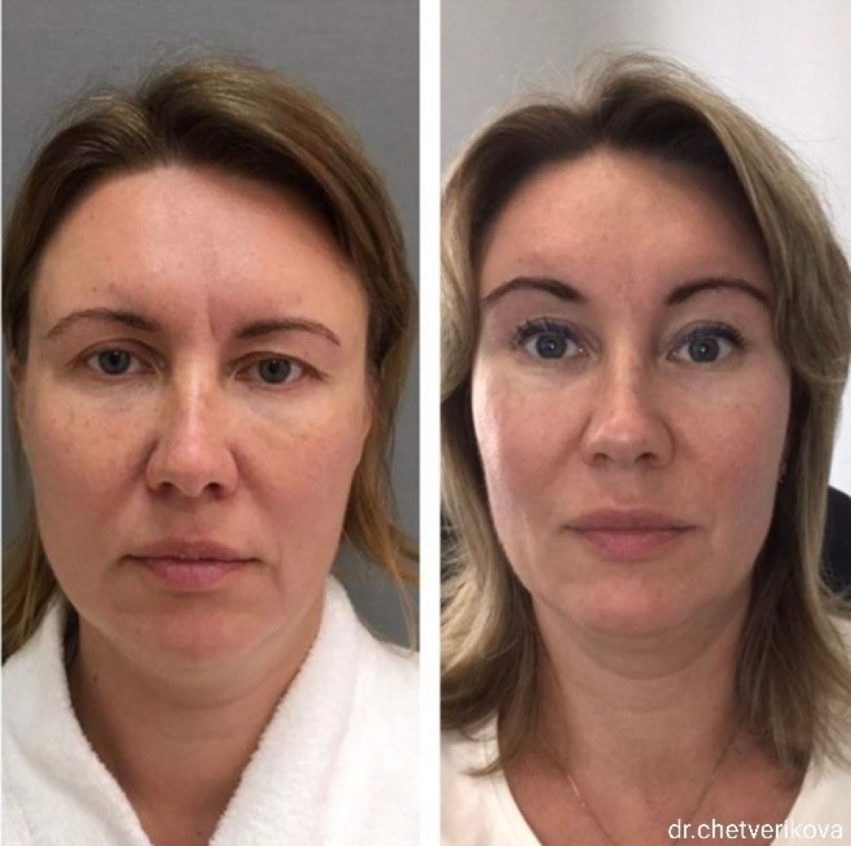 Пациентка пластического хирурга Марины Четвериковой до и через 2 года после омоложения лица.