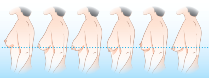 Примеры и степени провисания молочных желез. Иллюстрация