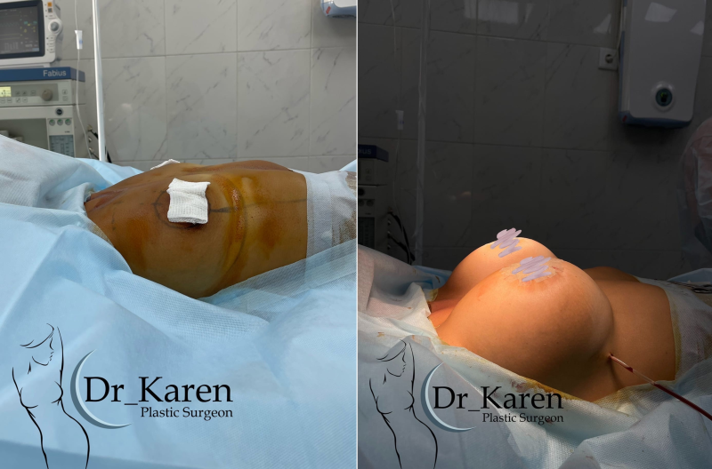 Фото пациентки пластического хирурга Карена Пайтяна до и после  увеличения груди с подтяжкой вокруг ареол