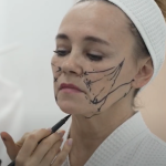 Нити — безоперационная подтяжка лица