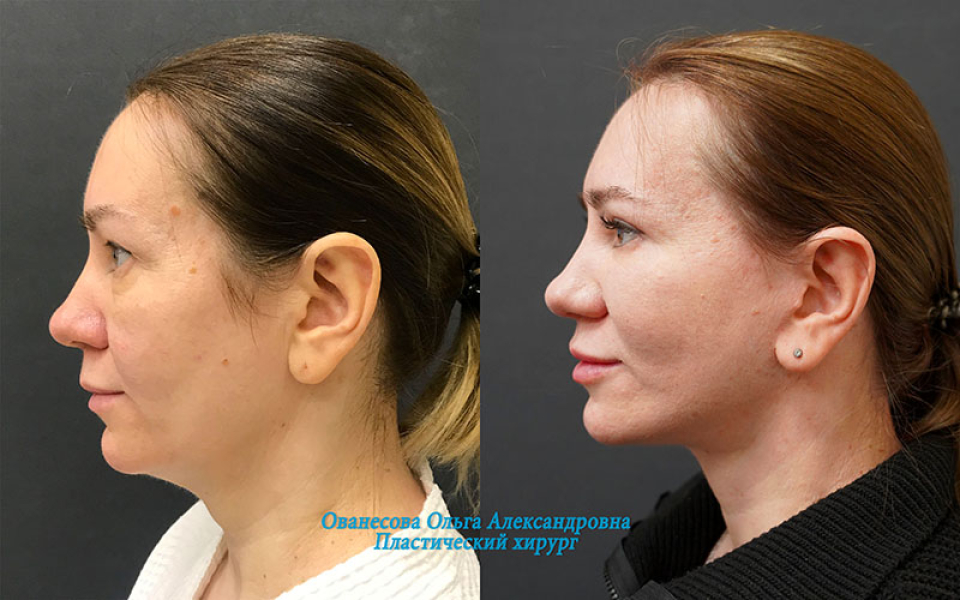 Пациентка доктора Ольги Ованесовой до и после комплексной подтяжки лица и шеи и удаления малярных мешков