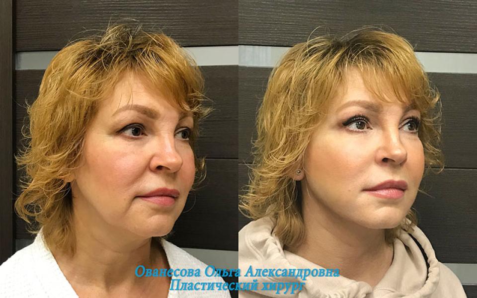 Пациентка пластического хирурга Ольги Ованесовой до и после операции по комплексной подтяжке лица и шеи