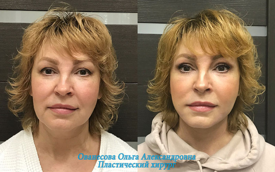 Пациентка пластического хирурга Ольги Ованесовой до и после операции по комплексной подтяжки лица и шеи