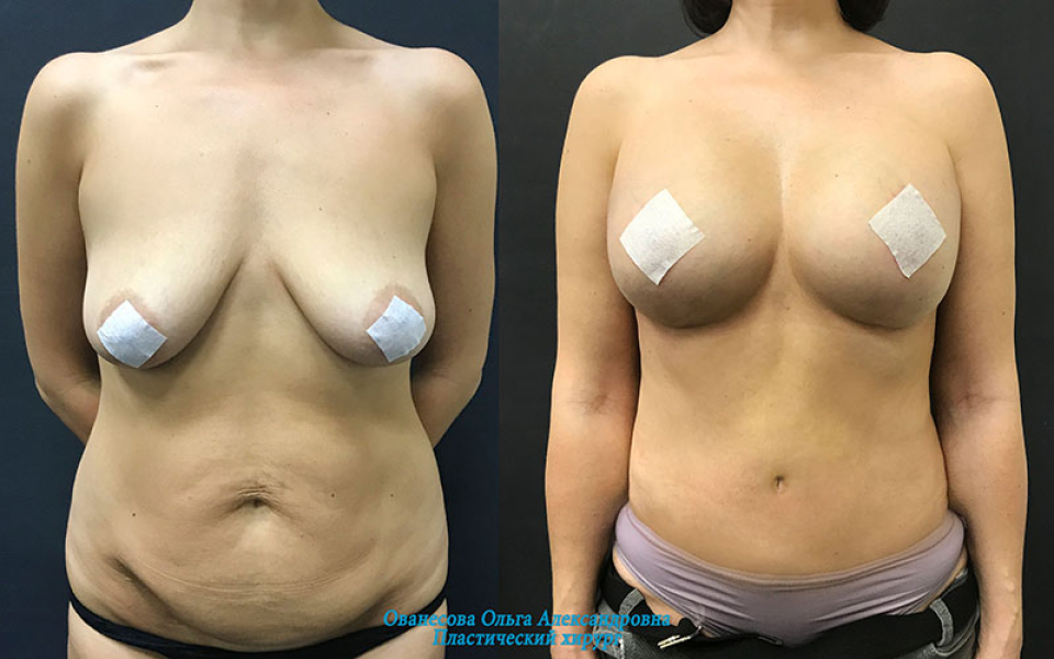 Пациентка пластического хирурга О. Ованесовой. Женщина обратилась с запросом на послеродовое восстановление фигуры