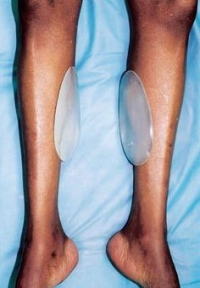 Не получается развить икры? Имплантаты как вариант